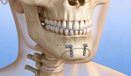 Mandibular Reconstruction Surgery